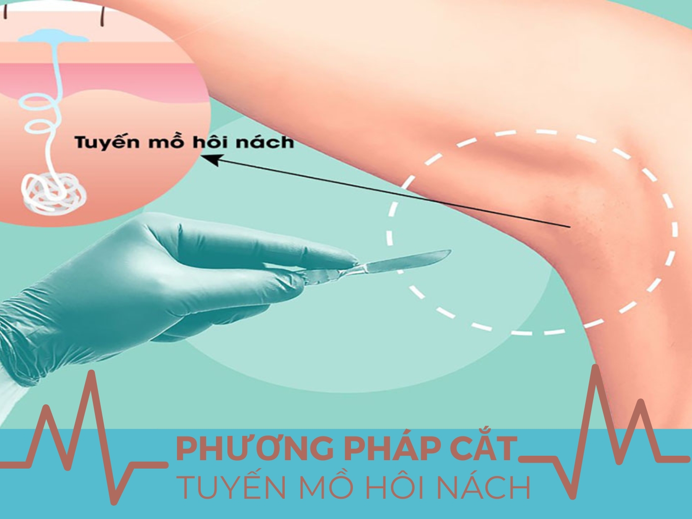 Cắt tuyến mồ hôi nách điều trị dứt điểm 